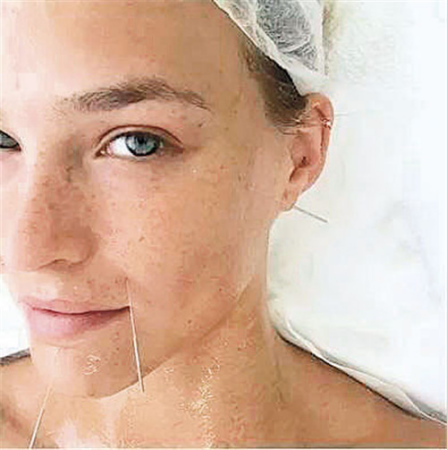 莱昂纳多前女友、以色列内衣超模芭儿·莱法利(Bar Refaeli)曾在社交平台上分享了自己面部针灸时的样子,照片中芭儿素颜正躺,脸上多个穴位规则布针。(美国《侨报》摘自网络图片) 莱昂纳多前女友、以色列内衣超模芭儿·莱法利(Bar Refaeli)曾在社交平台上分享了自己面部针灸时的样子,照片中芭儿素颜正躺,脸上多个穴位规则布针。(美国《侨报》摘自网络图片)
