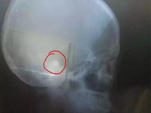 伤者急需开颅手术。(图片来源：莫桑比克华人报)