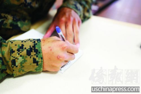 刘中杰手上已经满是伤痕。(美国《侨报》/陈沉 摄) 刘中杰手上已经满是伤痕。(美国《侨报》/陈沉 摄)