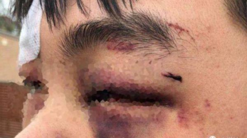 锐参考|中国在这个国家的所有使领馆,首次“群发”了同一个警告 遭受殴打的中国留学生(图片源自澳媒) 锐参考|中国在这个国家的所有使领馆,首次“群发”了同一个警告 遭受殴打的中国留学生(图片源自澳媒)