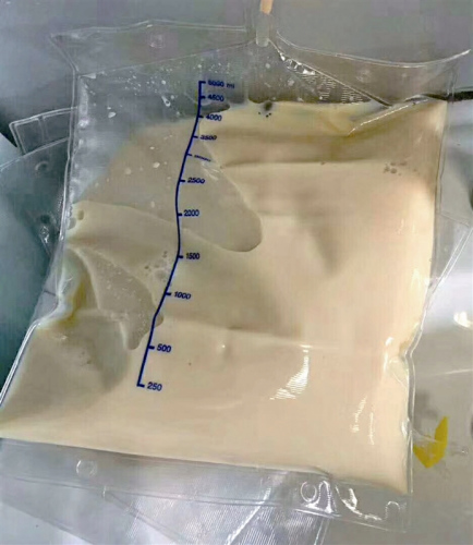小萍体内置换出的血浆像猪油一样 院方供图。 小萍体内置换出的血浆像猪油一样 院方供图。