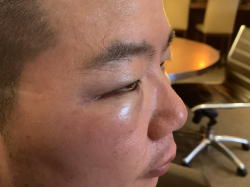 华裔家庭日前在法拉盛遭非洲裔侮辱、攻击、性骚扰、砸车,华裔父亲脸部被揍多拳,右眼瘀青肿涨严重。(来源:美国《世界日报》记者赖蕙榆 摄 ) 华裔家庭日前在法拉盛遭非洲裔侮辱、攻击、性骚扰、砸车,华裔父亲脸部被揍多拳,右眼瘀青肿涨严重。(来源:美国《世界日报》记者赖蕙榆 摄 )
