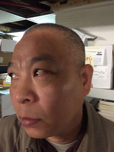 中国侨网殷成华被青少年打伤左眼,事隔多日,眼上的乌青与眼睛里的血丝仍清晰可见。(美《世界日报》/黄伊奕 摄)