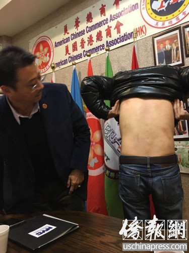 受害华青之一向布碌仑亚总会会长陈善莊求助,展示被打惨状(侨报记者