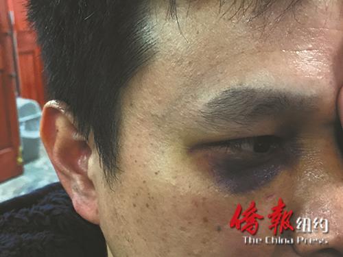 郑先生被袭后眼睛淤血肿胀。(美国《侨报》/陈辰