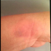 陈小姐展示手机照片称，手腕曾遭丈夫抓瘀青。(美国《世界日报》)