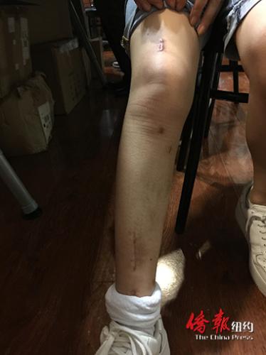 严重骨折的陈女士至今未从右腿的伤痛中康复过来。(美国《侨报》/崔国萁