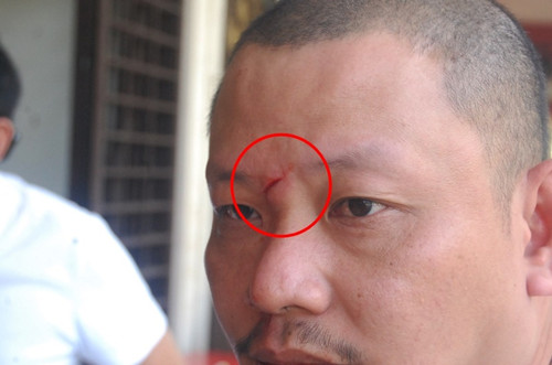 男子挥刀伤及古姓伤者的眉心（红圈处）。（马来西亚《星洲日报》）