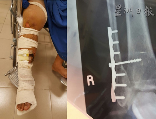 中国侨网事主的右脚骨断,必须通过手术置入螺钉及钢板固定骨折处,留院治疗超过1个月。(马来西亚《星洲日报》)