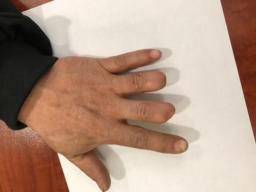 中国侨网华裔装修工被锯断两根手指，获赔42.5万美元。（美国《世界日报》）