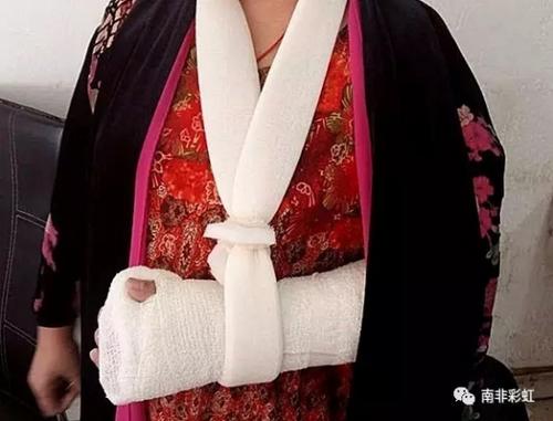中国侨网受害者胳膊被歹徒拧断,造成多处粉碎性骨折。(《南非华人网》)
