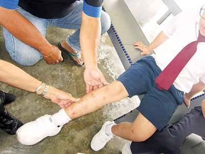 中国侨网一名学生的小腿被昆虫叮咬至伤痕累累。（马来西亚光华网）