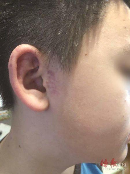 中国侨网华裔学生被打伤。(纽约《侨报》)