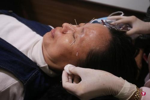 中国侨网参与临床研究的干眼患者陈华妹，在接受针灸和眼药水治疗后，症状显著改善。针灸眼周穴位约10分钟后，她因泪腺受刺激，流下眼泪。（新加坡《联合早报》/林国明 摄）