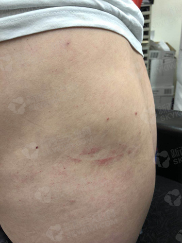 daniel被撞得满是乌青的后背