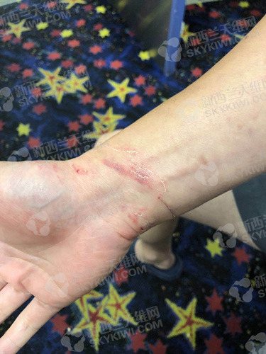 daniel手上的擦伤痕迹