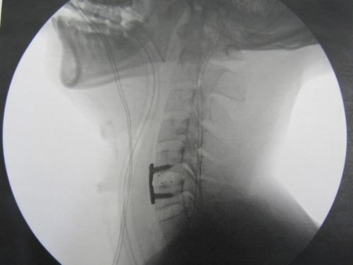 中国侨网经过医生诊断和多次手术后，陈先生被装上假体颈椎。(记者颜嘉莹╱翻摄)